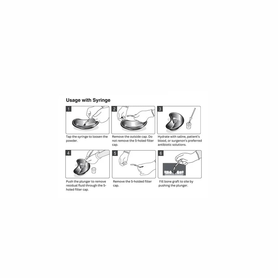 OsseoSeal™ Mineralized Allograft Syringe (0.5cc) | 50/50 Cortico-Cancellous