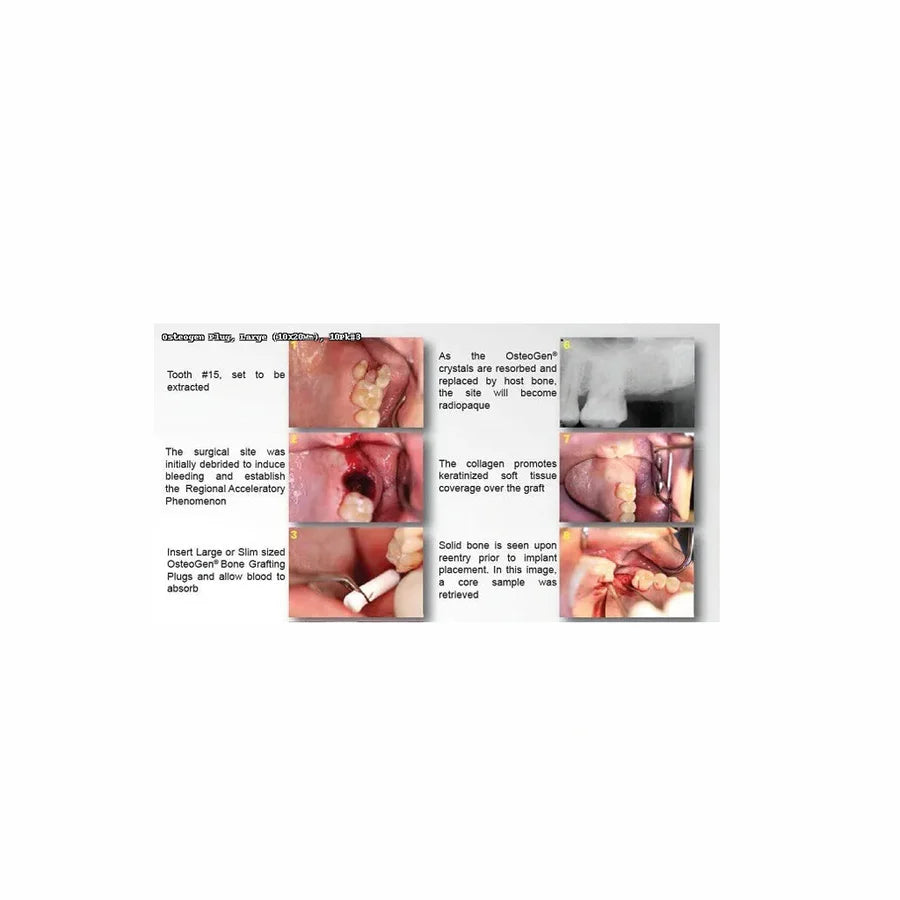 OsteoGen® Collagen Plug — 10 × 20 mm (Large)