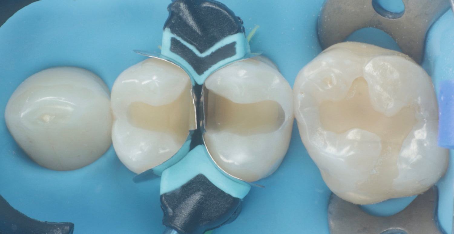 How to Choose the Correct Matrix Band Height: An Anatomical Guide for Class II Restorations