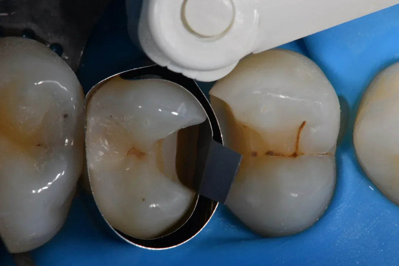 The Science Behind NiTi Separation Rings: Why Tooth Separation Matters in Class II Restorations
