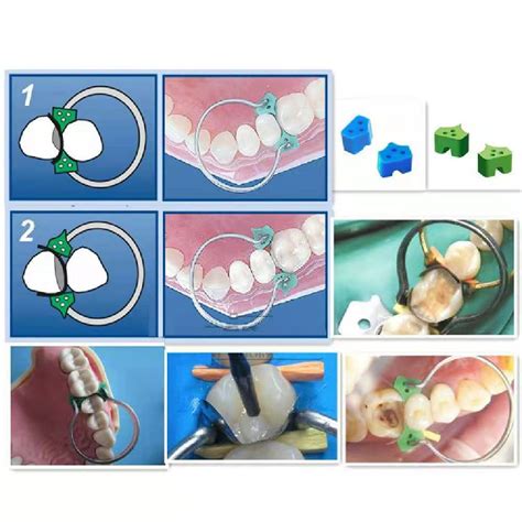 Troubleshooting Class II Composite Failures: Fix Open Contacts, Flat Margins & Gingival Gaps