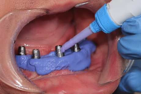 Implant Impression Materials: Achieving Accuracy in Complex Restorative Cases