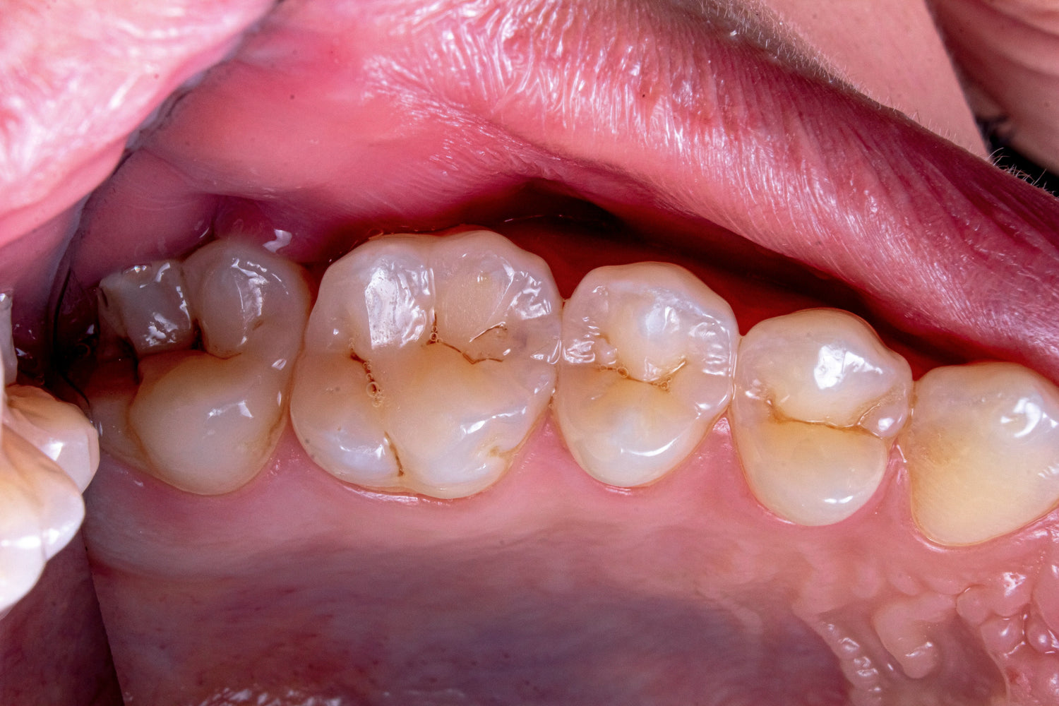 Bulk Fill vs Injectable Flowables: Choosing the Right Composite for Daily Restorations