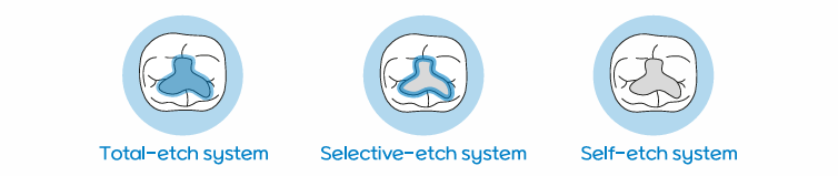 Self-Etch vs Total-Etch: Choosing the Right Bonding Workflow