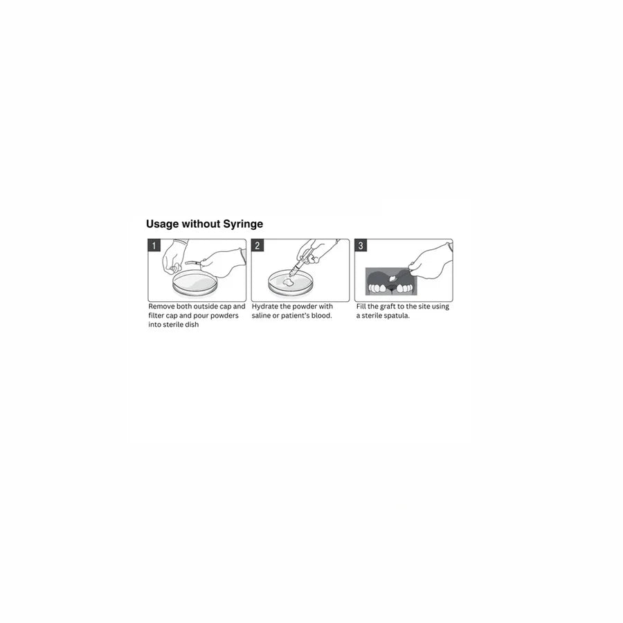 OsseoSeal™ Mineralized Allograft Syringe (0.5cc) | 50/50 Cortico-Cancellous