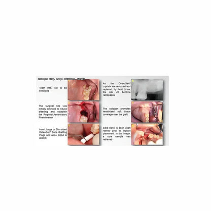 OsteoGen® Collagen Plug — 10 × 20 mm (Large)