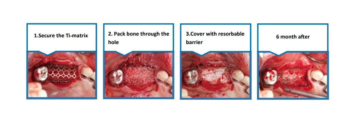 Rigid GBR Membrane (Type B / Type C)
