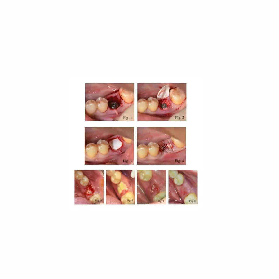 Textured ePTFE GBR Membrane