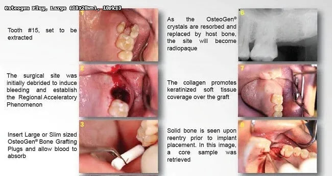 OsteoGen® Collagen Plug — 10 × 20 mm (Large)